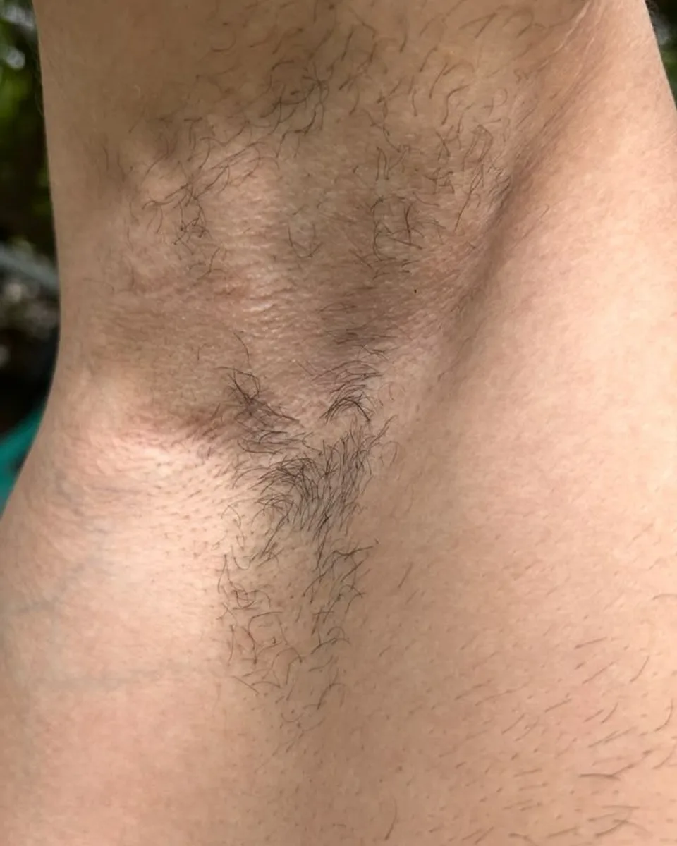 After: Underarms